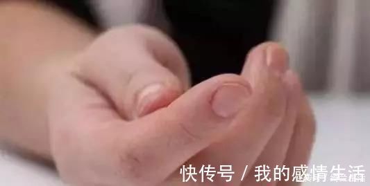 横纹|大拇指上暗藏的中风信号,一旦出现赶紧就医