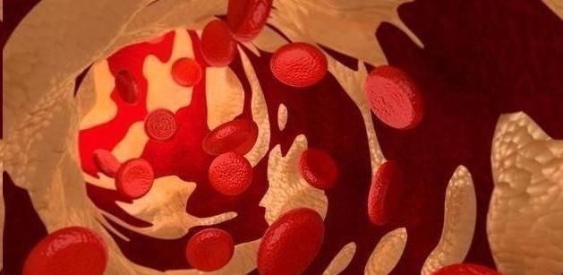 救命恩人|脑梗的“救命恩人”来了,家中常备,血管不堵、血脂稳稳的