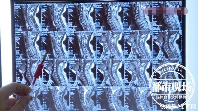 湖南省胸科医院|女子按摩后路都走不了,医生:再按要瘫痪