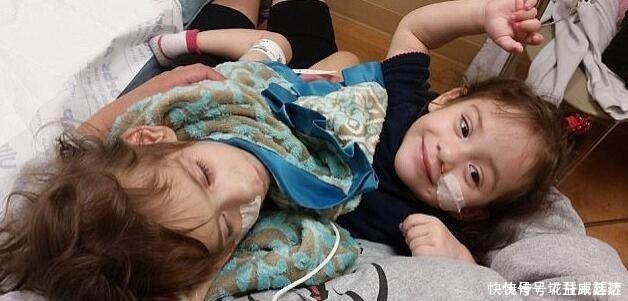 父母|连体双胞胎做分离手术成功,每人分得一条腿,父母喜极而泣!
