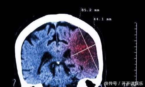 控制血压|血压高到多少会脑出血?2个案例告诉你,高血压病人最好了解一下