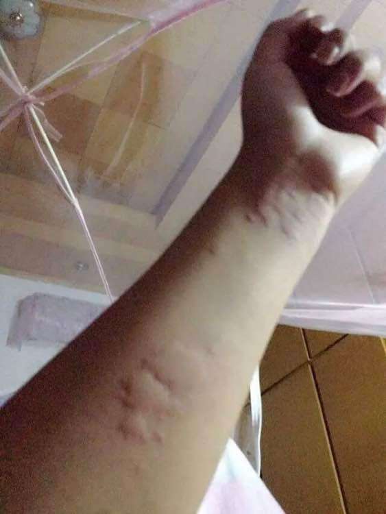 风邪|七年荨麻疹,用一味中药就消了!我老师的“险招”值得研究