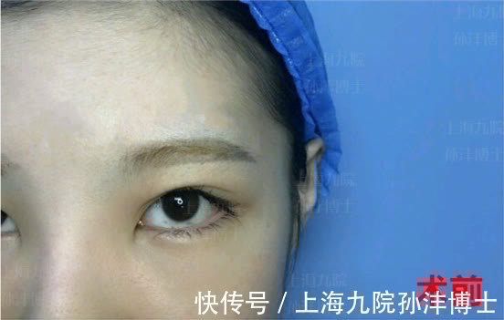 泪液 孙沣博士:双眼皮手术后,眼睛总爱流泪是正常情况吗?