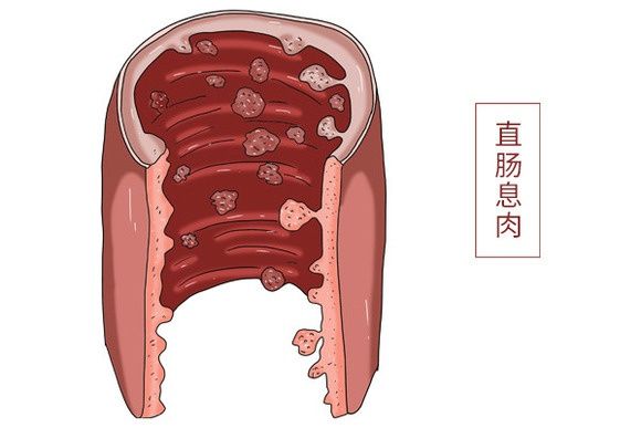 癌变|肠息肉有3种，哪种需要切除？会不会癌变？一文统统告诉你