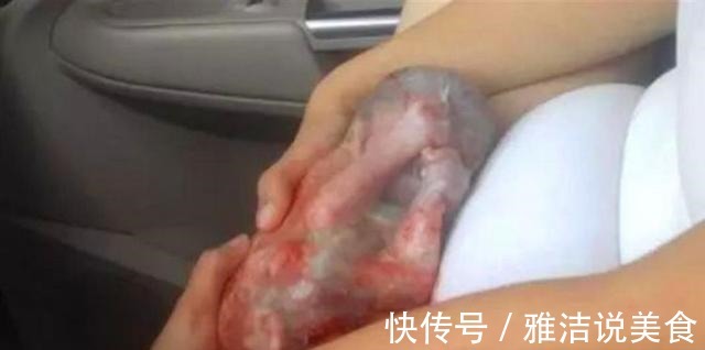 孕期|现实版“哪吒”产妇生下“带壳”宝宝痛哭,医生却说恭喜你