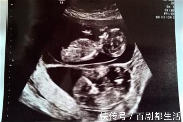 妻子|做亲子鉴定,双胞胎不是一个爸?医生:你妻子狡辩不了