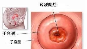 继发性痛经|大夫：5个妇科常识，自己知道后也告诉自己的女儿，一起了解下