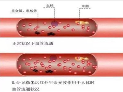 慢慢堵塞的人体血管，用四种食物清除血管中垃圾