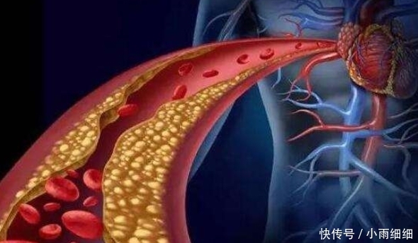 人到中年|人到中年血管最怕“堵”,3种食物可多吃,可软化血管预防堵塞