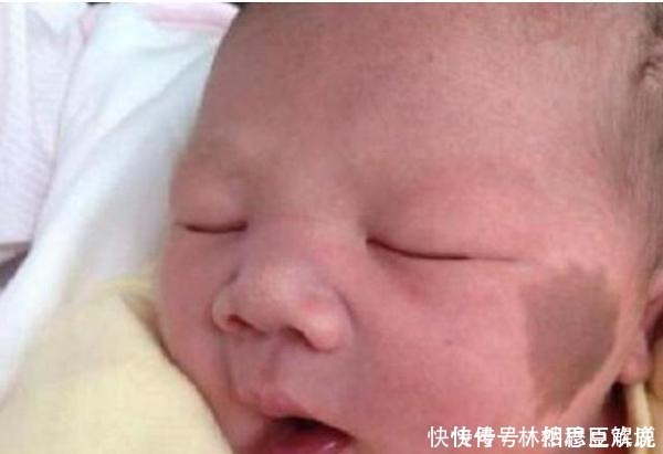 妈妈|胎记咋来的产科医生除了遗传,还与孕期的这3种行为有关
