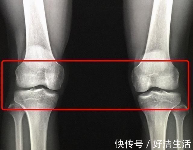 发育|14岁男孩身高153，检查后医生：骨骺线已闭合，最多还能长2-3㎝