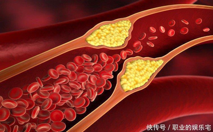 他汀药物的4个常见副作用,医师提醒:6种方法可降低风险