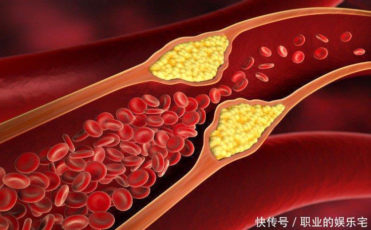 他汀药物的4个常见副作用，医师提醒：6种方法可降低风险