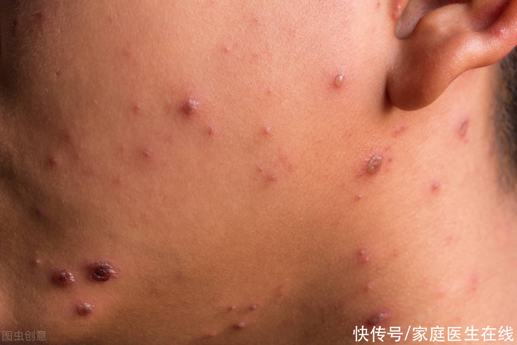 得了梅毒感觉天都塌下来了 其实没那么可怕 做好6件事可治愈 全网搜