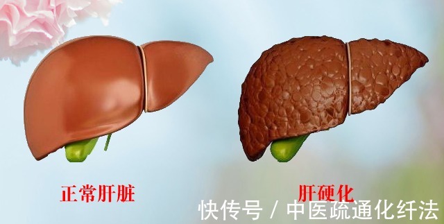 抗病毒治疗|乙肝肝硬化能治愈吗？