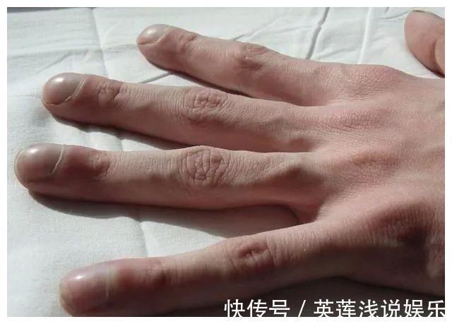 慢性肝炎|体内有“癌”,手脚先知!医生提醒:手脚出现这4种变化,不要拖