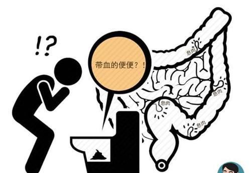  肠癌|为何年纪轻轻会患上肠癌？若有这6个异常，要及时做肠镜检查