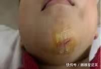 小宝|孩子误吞硬币、意外受伤该怎么办?儿科医生提醒:这样做才正确