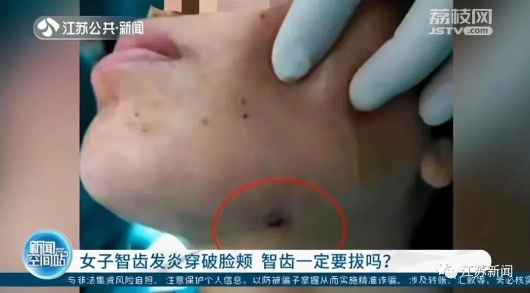 扬州大学|可怕！智齿反复发炎，女子脸颊竟烂穿一个洞！