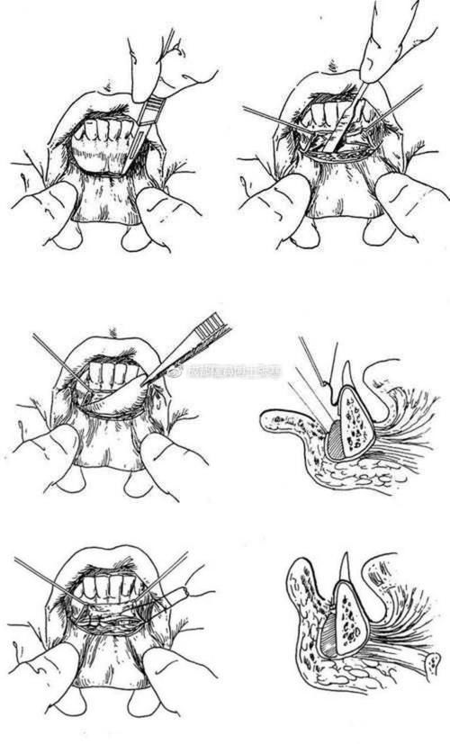 t截骨|下巴整形的3种方法:注射、假体、T截骨,哪个适合你?区别在哪?