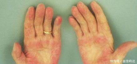 体征|肝脏不痛不痒,可当出现这6个体征时,可能你的肝正在坏掉