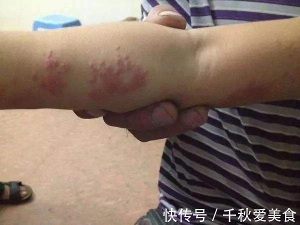 托叶|根治带状疱疹，只需一味草药，治标又治本！