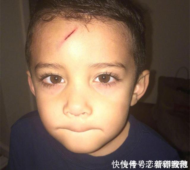 男孩不小心磕破了额头,宝妈灵机一动,让娃变成了“哈利波特”