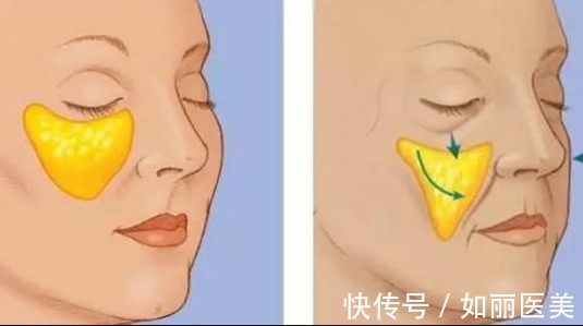 自体脂肪 自体脂肪填充术后能保持多久,会不会很快代谢掉?