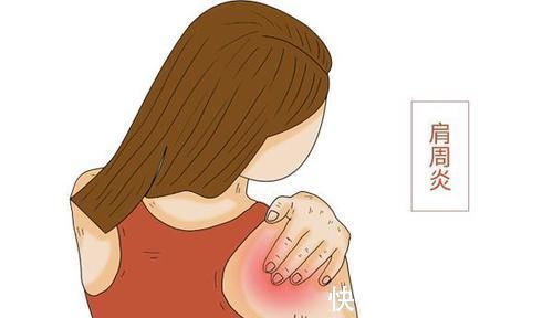 补钙|女人迈入更年期，容易被3种骨病“缠上”，有哪些方法能预防？