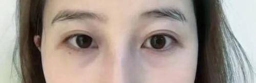 不用医美就可以解决？谁说眼袋不可逆～