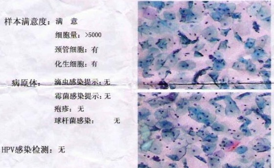 hpv|宫颈不是“哑巴”，上厕所3个迹象，十有八九是HPV来了