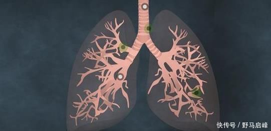 肺癌|肺癌一发现都是晚期错早期往往有蛛丝马迹,是身体在向你求救