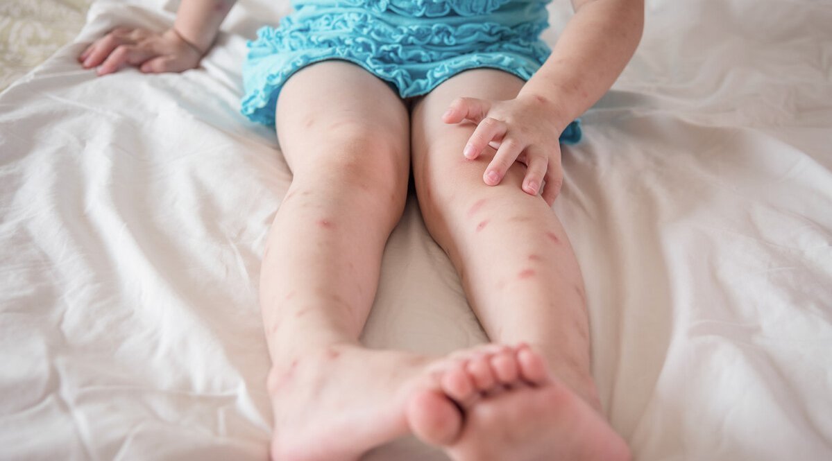 免疫系统|夏天被蚊子扰得不厌其烦?医生教你科学方法,轻松让蚊虫去咬别人