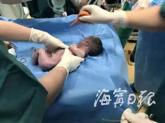 放弃|孕妇产子情况危急,父亲打算放弃孩子前一句话让人泪崩