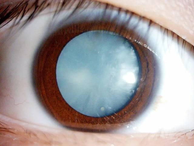 主任医师|15岁男生拿可乐当水喝，得了白内障，右眼几乎完全失明！医生这样提醒