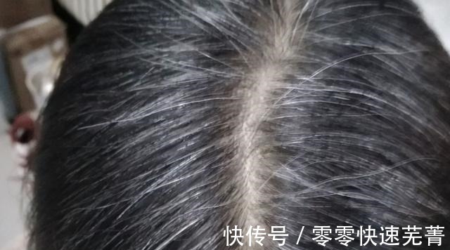 衰老|为啥白发越长越多医生并非衰老这么简单,或是缺乏3种营养素