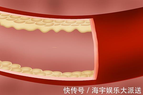 老年人|老年人定期输液,能冲走血管垃圾,预防中风有必要定期输液吗