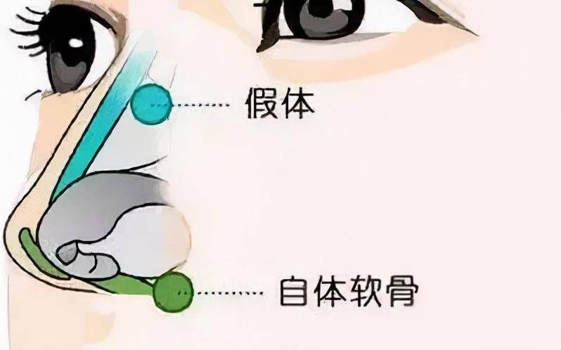 耳软骨|杭州美莱隆鼻科普：想做耳软骨隆鼻的人，你真觉得自己鼻子适合吗