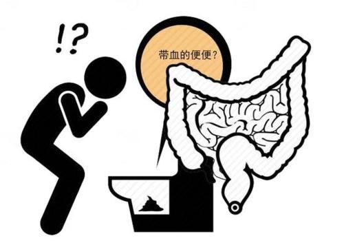 癌肿|晨起一个症状，可能是肠癌“征兆”，很多人都忽视了！