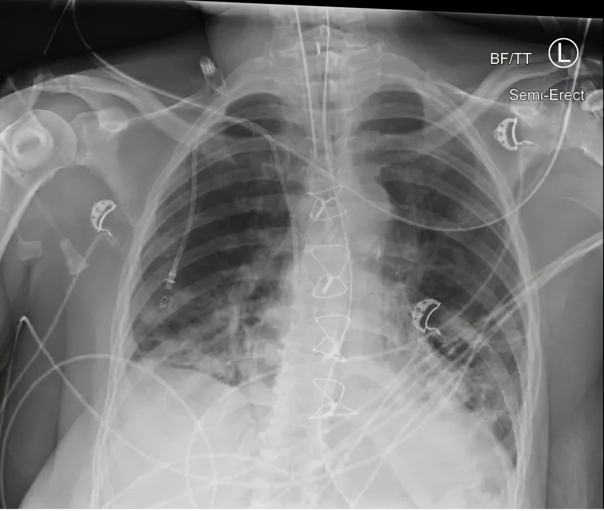疫苗|选择的勇气:拒绝接种新冠疫苗的女士,签署了不抢救医疗遗嘱