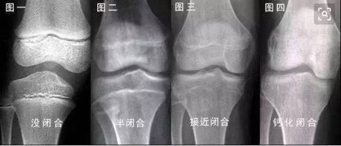 生物蛋白锌|男生身高发育有“终止线”，这个年纪若还没有170很难再往上长