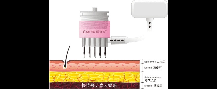 收敛毛孔,除了光子嫩肤,这两种方法也很出色