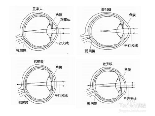 导致很多人近视的原因是什么?