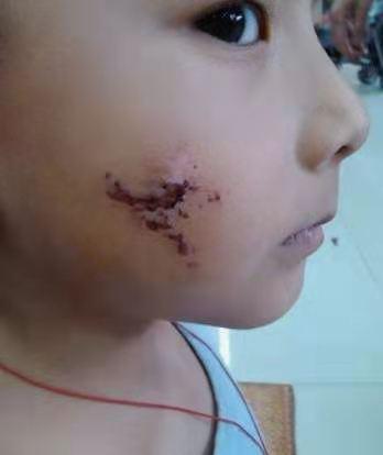 产妇|四年前因吃奶用力过猛,被母亲用剪刀划花脸的男童,如今怎么样了