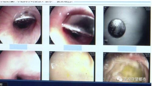 三岁男童频呛咳，竟是西瓜籽惹的祸...