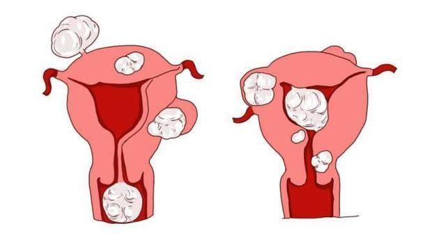 子宫肌瘤能不能怀孕，怀孕发现子宫肌瘤怎么办