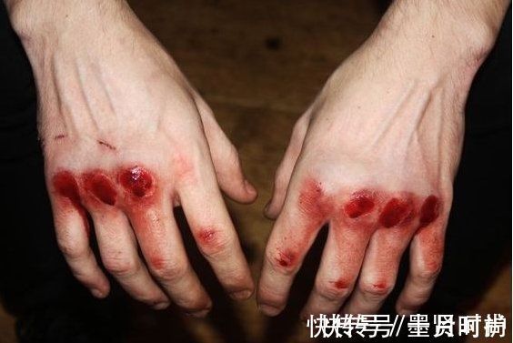 手指|三岁女童被活活截断手指,终生残疾!只因用错创可贴,快自查