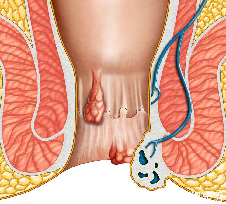 槐角丸|2个痔疮“土偏方”连用7天，内外痔慢慢没了，真灵！