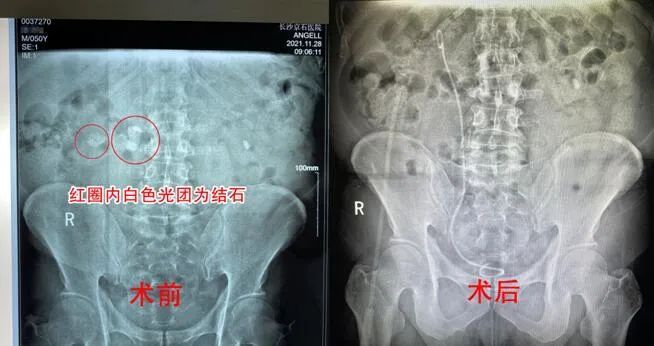 结石|男子偏爱喝浓茶，因此进了医院…