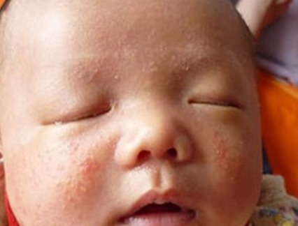 豌豆|新生儿宝贝长了好多湿疹,什么原因,2招教你快速搞定